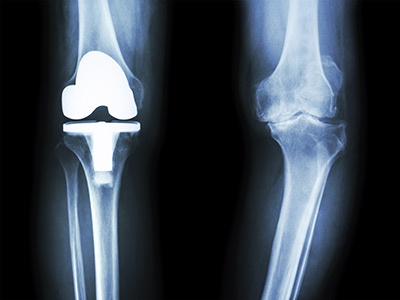 Knee Replacement Surgery Webster TX